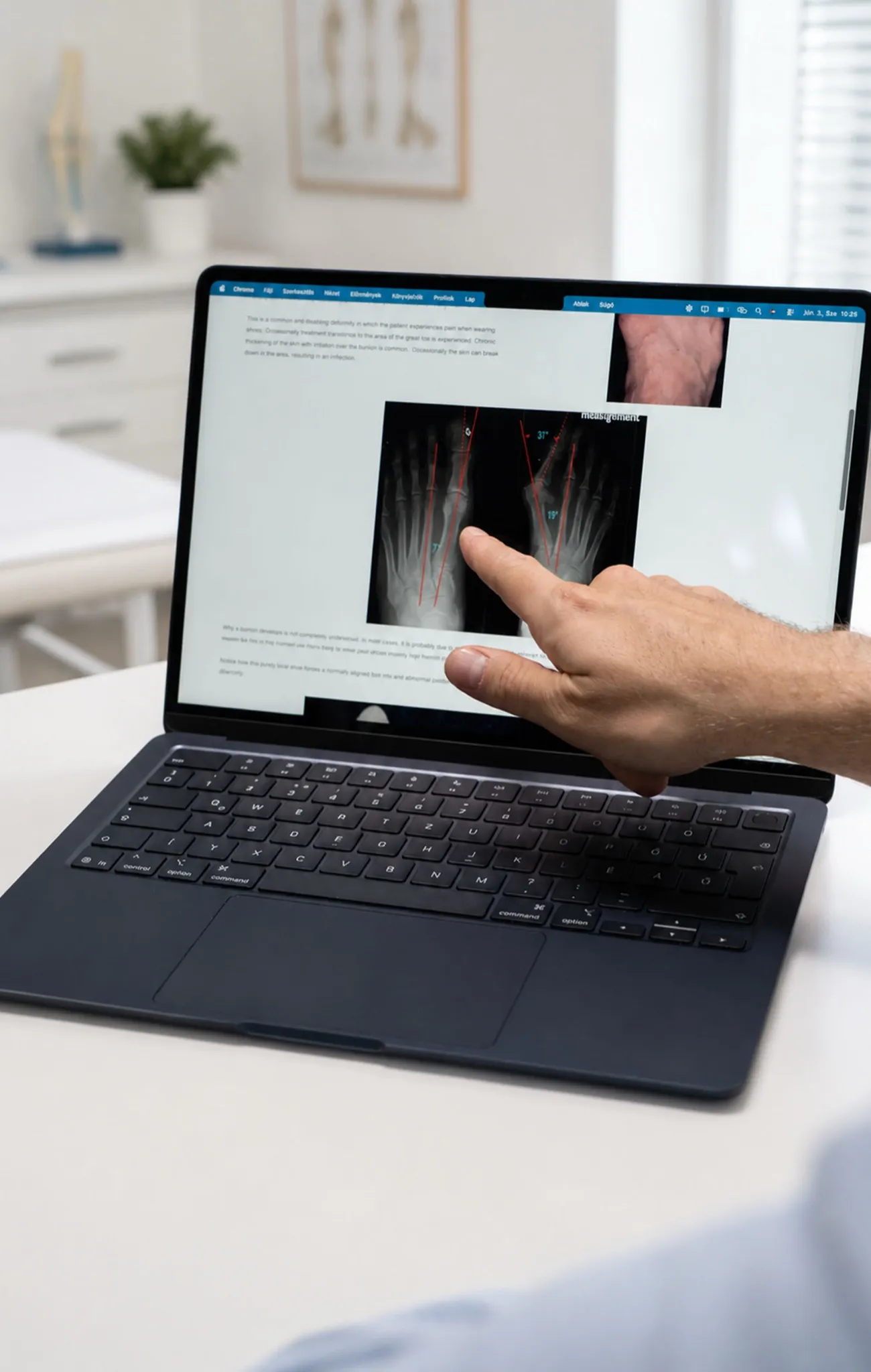 Laptop képernyőjén bütyök (hallux valgus) röntgenfelvétele szögméréssel, az orvos a deformitás tengelyére mutat