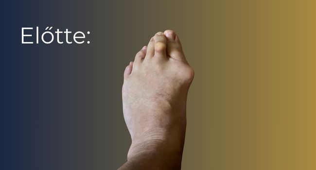 Bütyök műtét (hallux valgus korrekció) – állapot a beavatkozás előtt