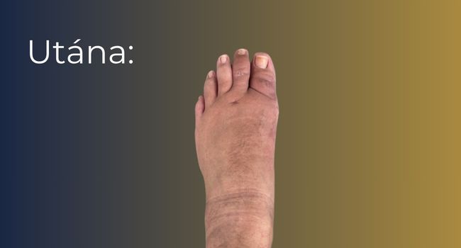 Bütyök műtét (hallux valgus korrekció) – eredmény a beavatkozás után