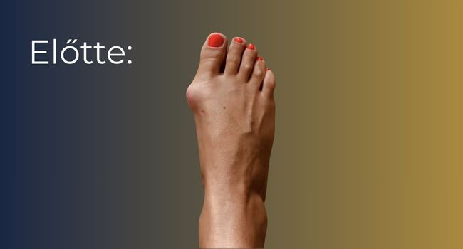 Bütyök műtét (hallux valgus korrekció) – állapot a beavatkozás előtt