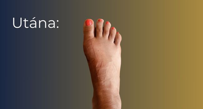 Bütyök műtét (hallux valgus korrekció) – eredmény a beavatkozás után