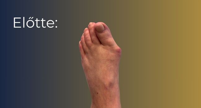 Bütyök műtét (hallux valgus korrekció) – állapot a beavatkozás előtt
