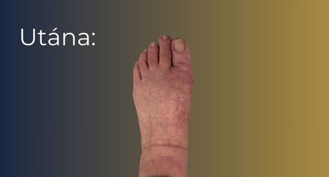Bütyök műtét (hallux valgus korrekció) – eredmény a beavatkozás után