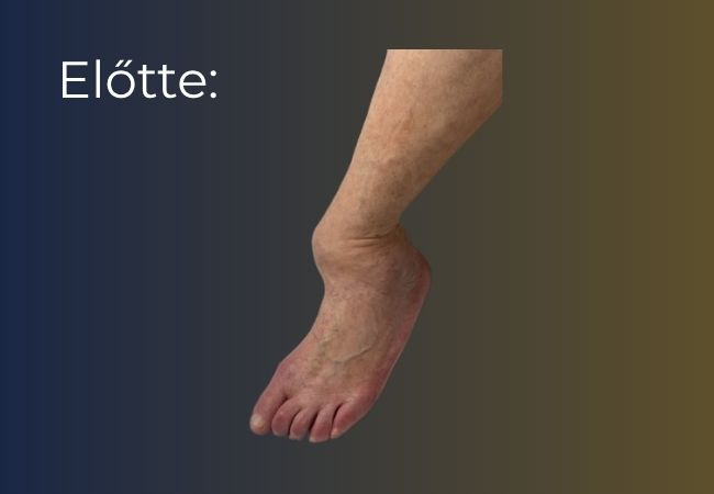 Traumás lábsebészeti műtétek – állapot a beavatkozás előtt