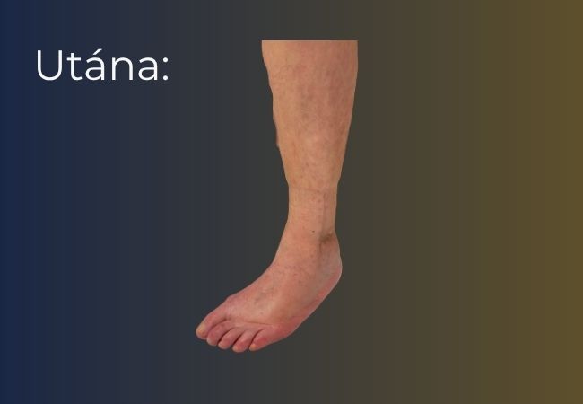 Traumás lábsebészeti műtétek – eredmény a beavatkozás után