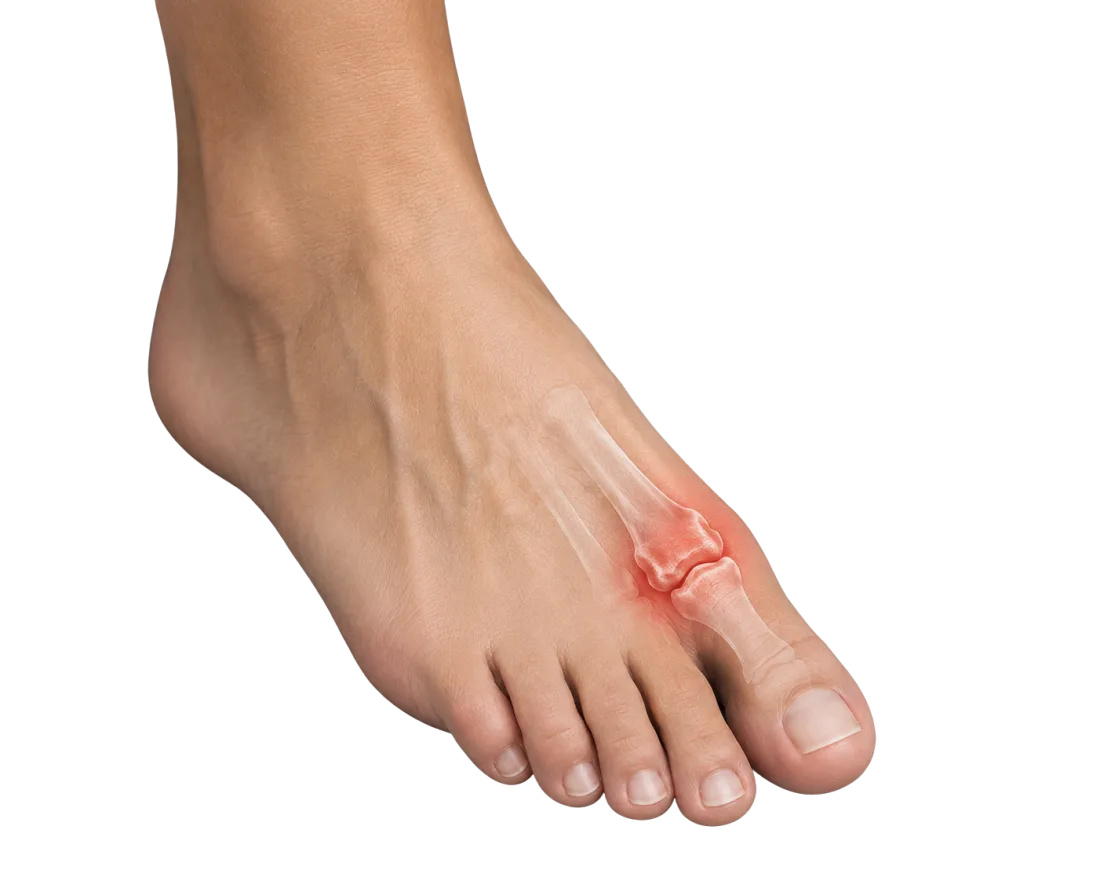 Hallux rigidus (a nagylábujj ízületi kopása)
