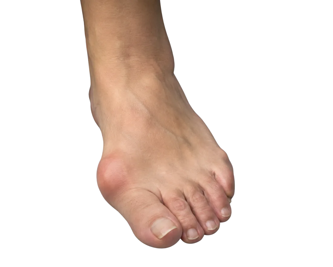 Hallux valgus (bütyök)