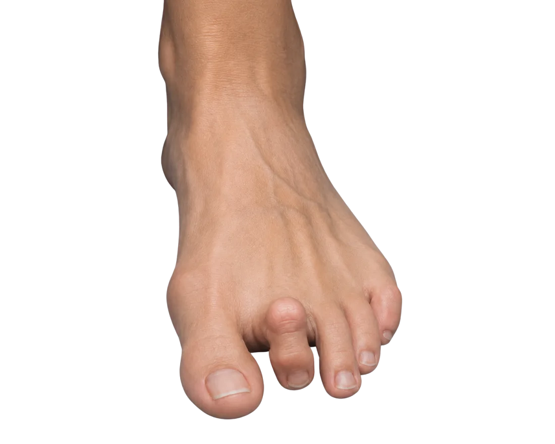 Kalapácsujj, egyéb lábujjdeformitások