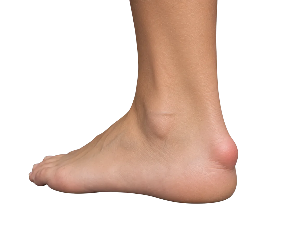 Sarokfájdalom – Haglund deformitás és Achilles-enthesopathia